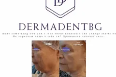 Процедура за лице и шия, Био - мезолифтинг, анти - ейдж