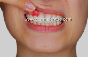 Много често при заболяване на венците:- пародонтоза; - гингивит; - афти, пациента не търси лекарска помощ. 