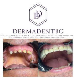 Зъбни корони и мостови конструкции - специализирана дентална медицина Когато зъбната структура е нарушена и възстановяването не може да се извърши с пломбировачен материал се изработват корони.