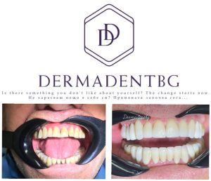 Зъбни корони и мостови конструкции - специализирана дентална медицина

Короните предпазват зъба от по - нататъшно счупване или разрушение, като дават възможност за промяна на цвета и формата на зъба.