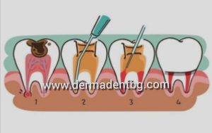 Лечение на нерва на зъба, следствие от ненавреманно лечение на зъбен кариес