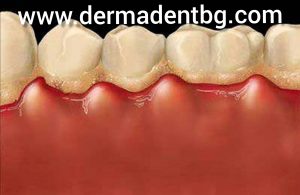 Ненавременното отстраняване на зъбния камък често води до проблеми с венците – кървене, зачервяване, оток и подуване на венечните пространства между папилите (зъбите ). С времето тези неразположения могат да прераснат в заболяване на венците наречено гингивит. Ако не се вземат навременни мерки гингивита води до развитието на пародонтит ( пародонтоза).