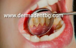 Зъбният камък представлява налепи по зъбите, които съдържат мъртви клетки, остатъци от храна и плака, при нередовното му почистване, той създава благоприятна среда за развитие на кариеси. Веднъж образувал се, зъбният камък може да се отстрани само от специалист. Защо ще разберете по-долу.