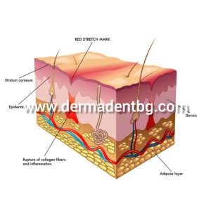 Стриите са следствие от нарушение на съединителната тъкан, реакция на кожата след прекоерно разтягане и разкъсване на колагеновите и еластиновите влакнаи свиване.