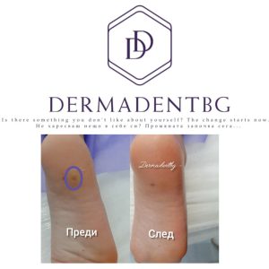 Естетичен център Dermadentbg Бургас, Премахване на кожни образувания ( лезии) с КриоПен