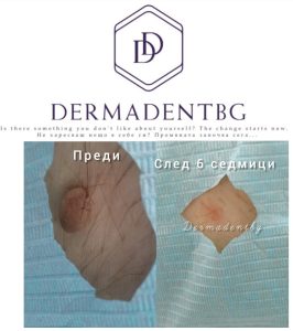 Естетичен център Dermadentbg Бургас - Премахване на кожни образувания ( лезии) с КриоПен