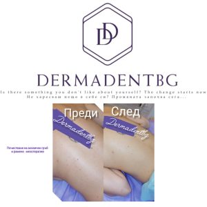 Естетичен център Dermadentbg Бургас - процедура за Почистване на гръб и рамене с дълбока водородна хидратация 2 в 1