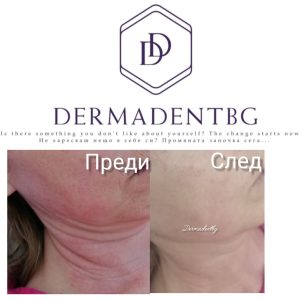 Естетичен център Dermadentbg Бургас, купероза, розацея, разширени капиляри
